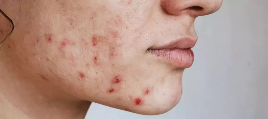 akne-izi