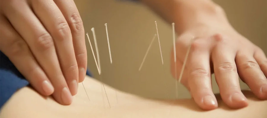 akupunktur