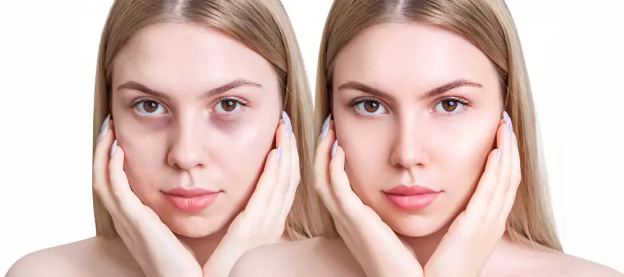 gozalti-mezoterapisi-6826e44b7167a