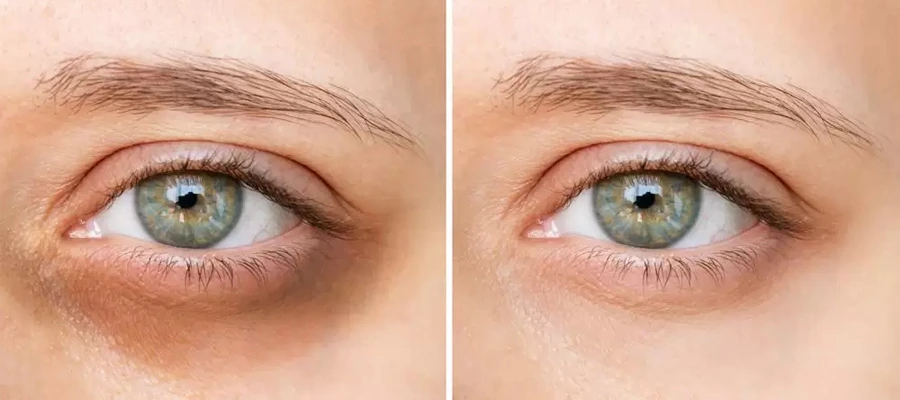 gözaltı-mezoterapisi