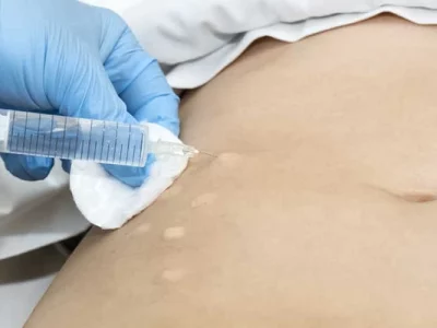 mezoterapi-ile-zayıflama